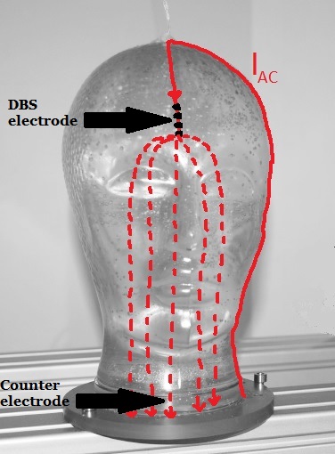 Fig. 5. Unipolar configuration of the DBS electrode.