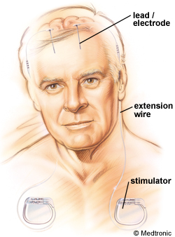 Fig. 1. Components of the deep brain stimulation [4].